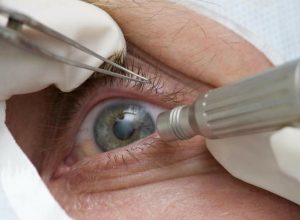 lula-faz-cirurgia-de-catarata;-entenda-a-doenca-e-o-procedimento